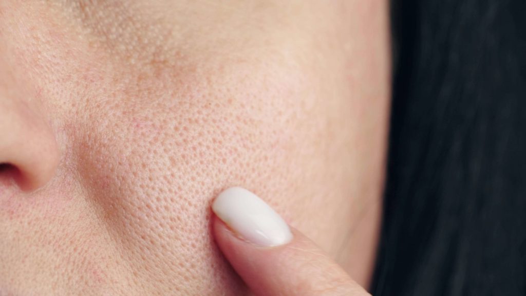 What Does MicroNeedling Actually Do