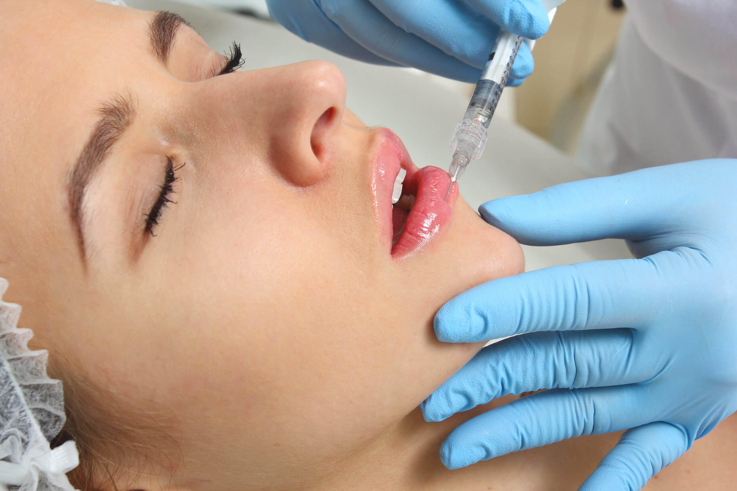 Lip Filler at Glow wellness care