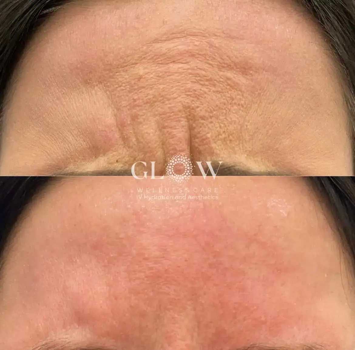 Botox Before-After (10)