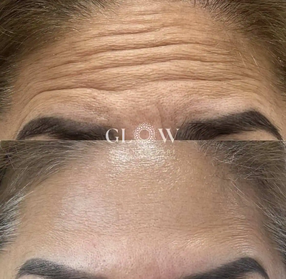 Botox Before-After (11)