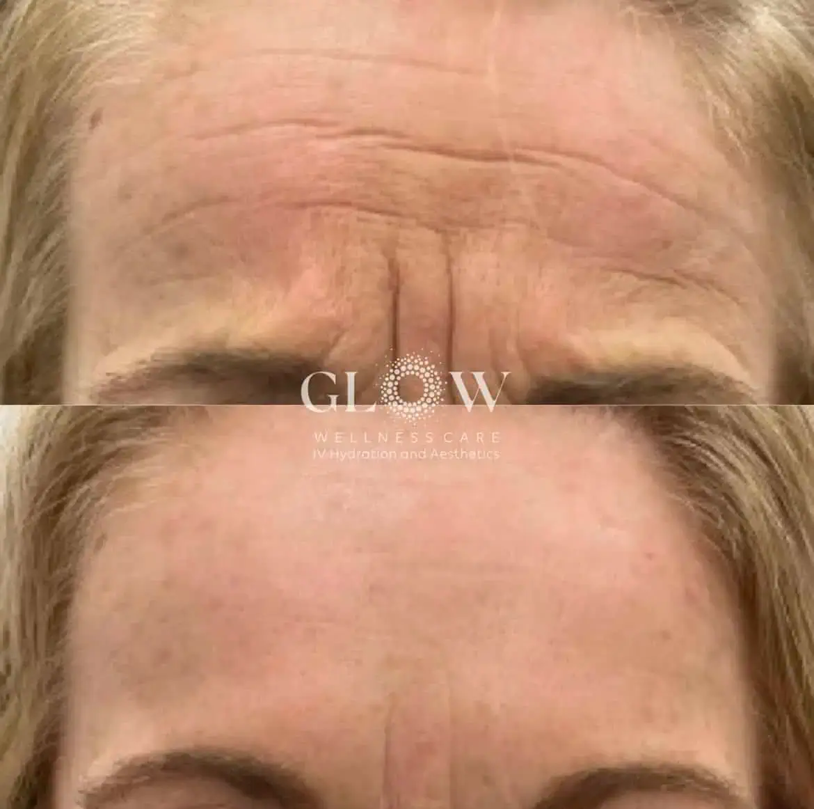 Botox Before-After (12)