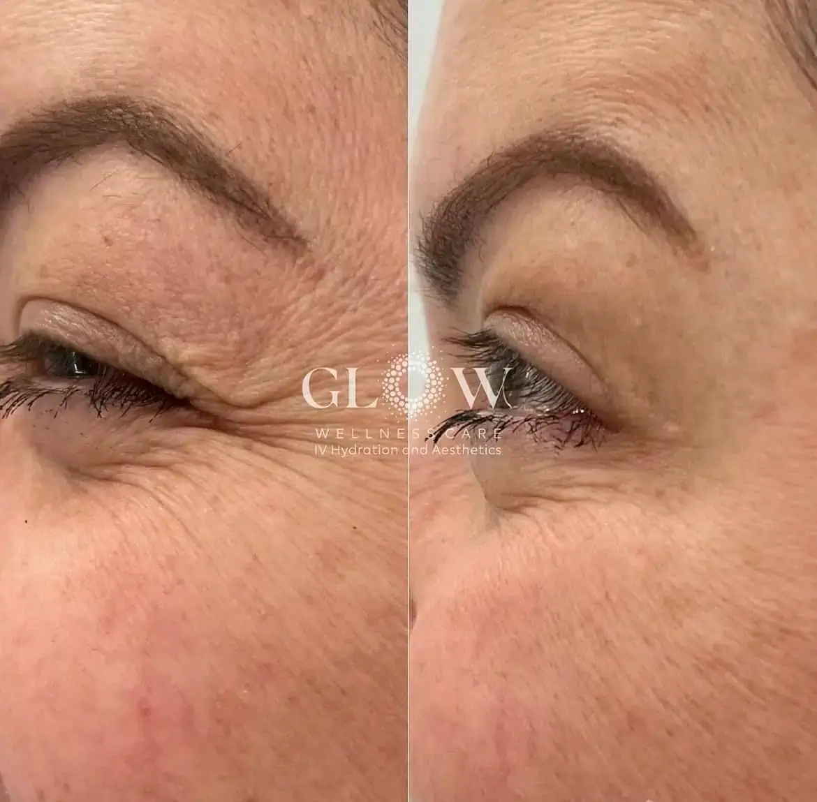 Botox Before-After (13)