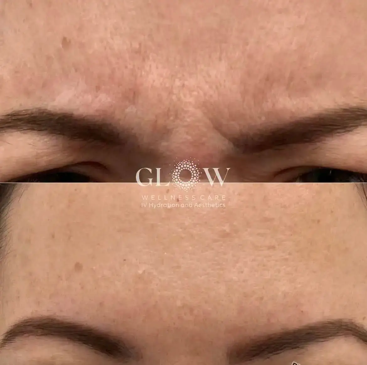 Botox Before-After (14)