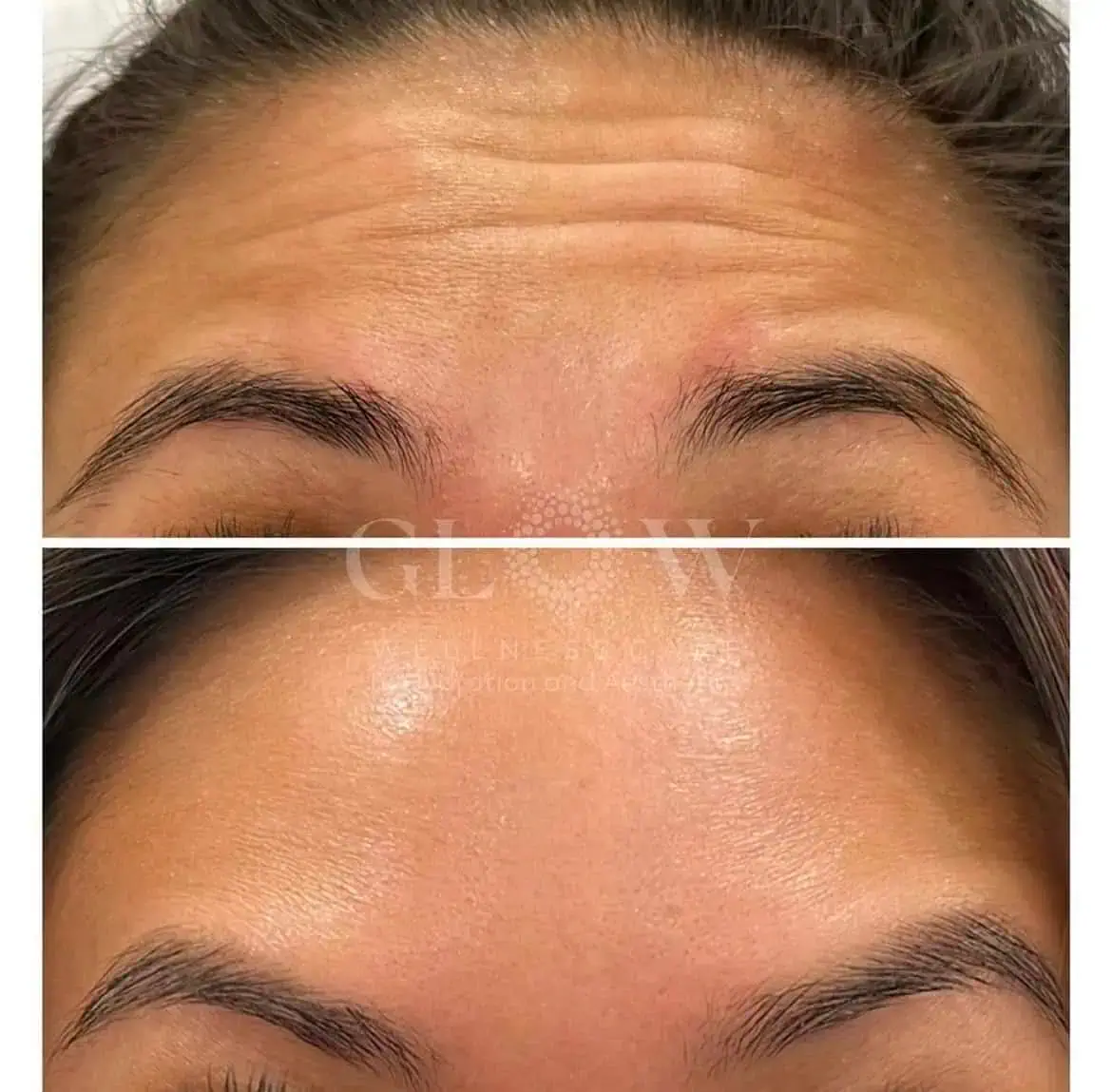 Botox Before-After (2)