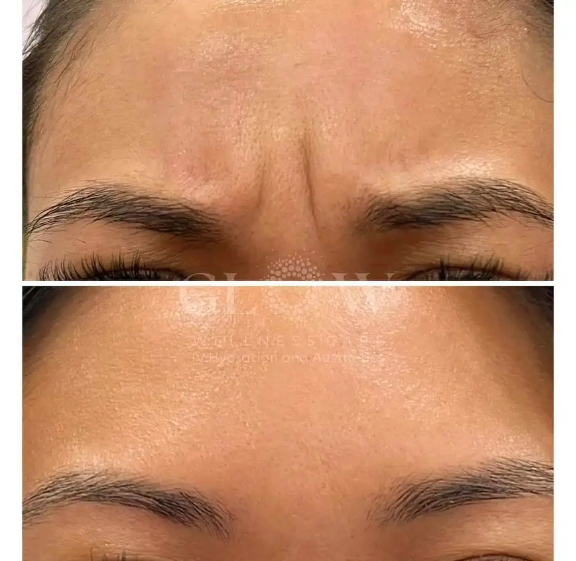 Botox Before-After (3)