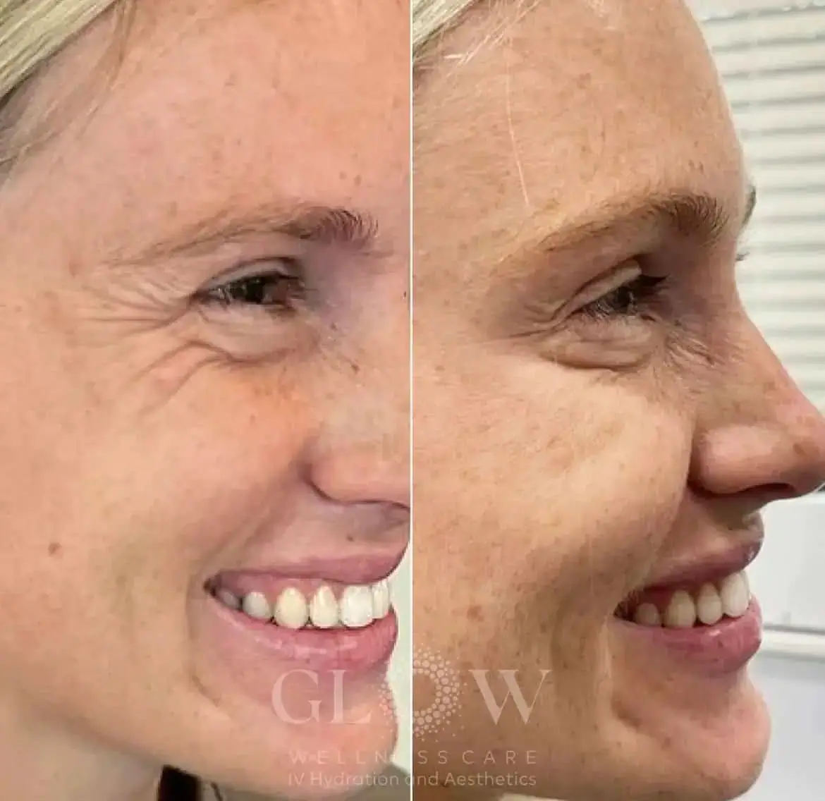 Botox Before-After (4)