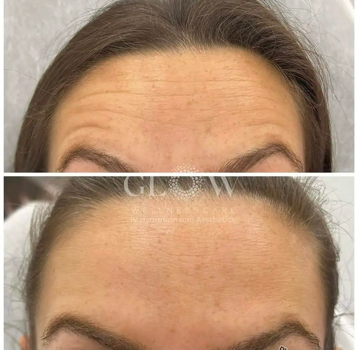 Botox Before-After (5)