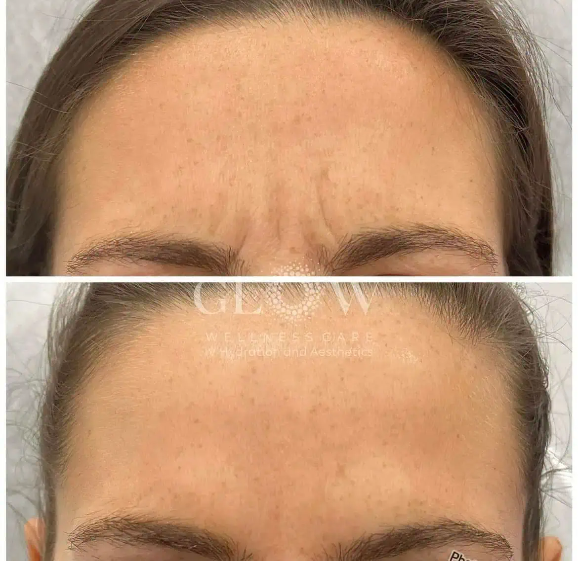 Botox Before-After (6)