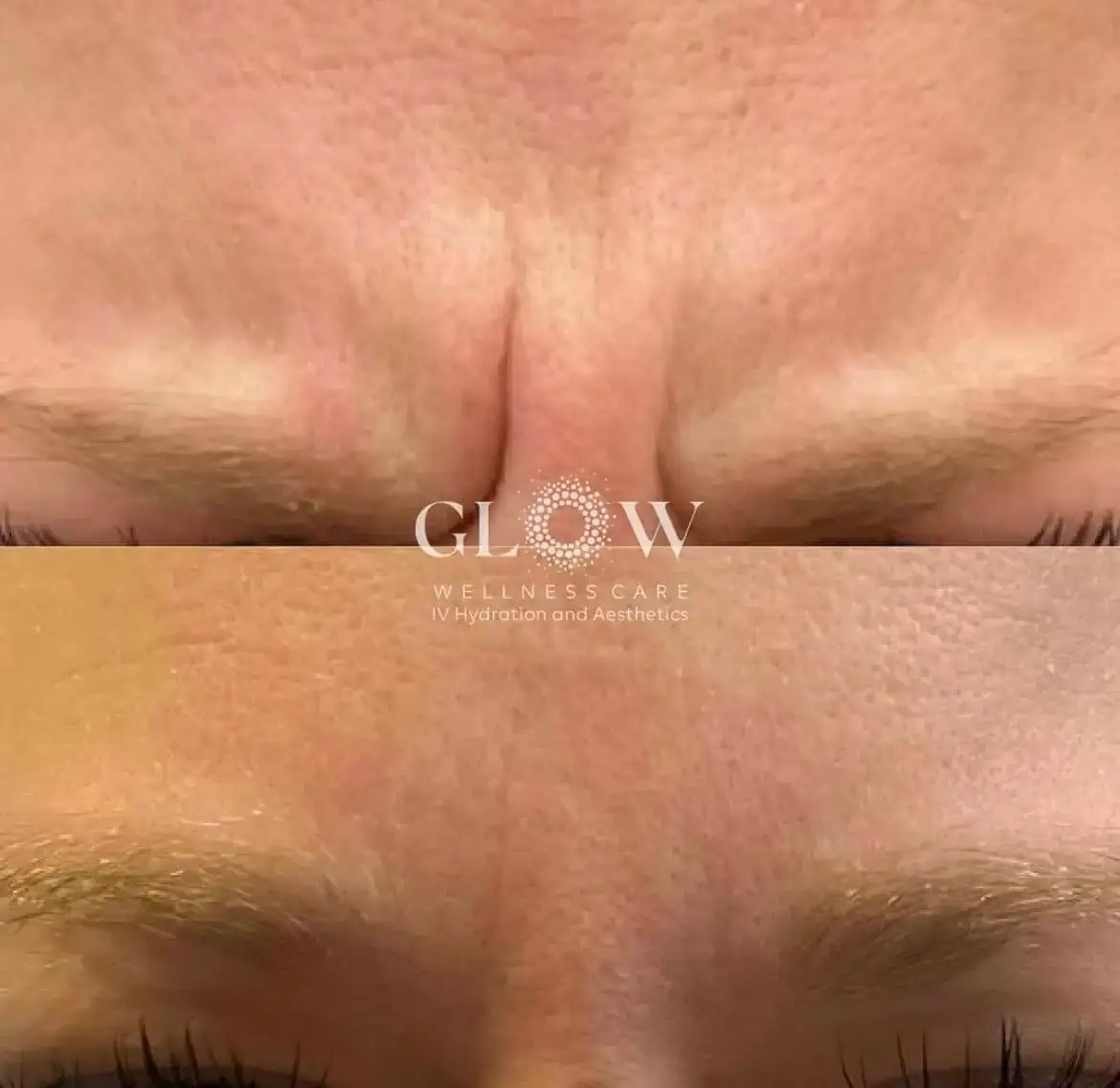 Botox Before-After (8)