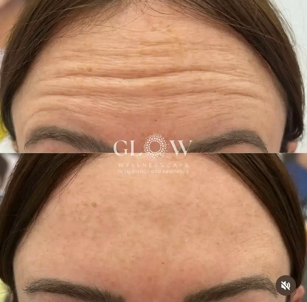 Botox Before-After (9)