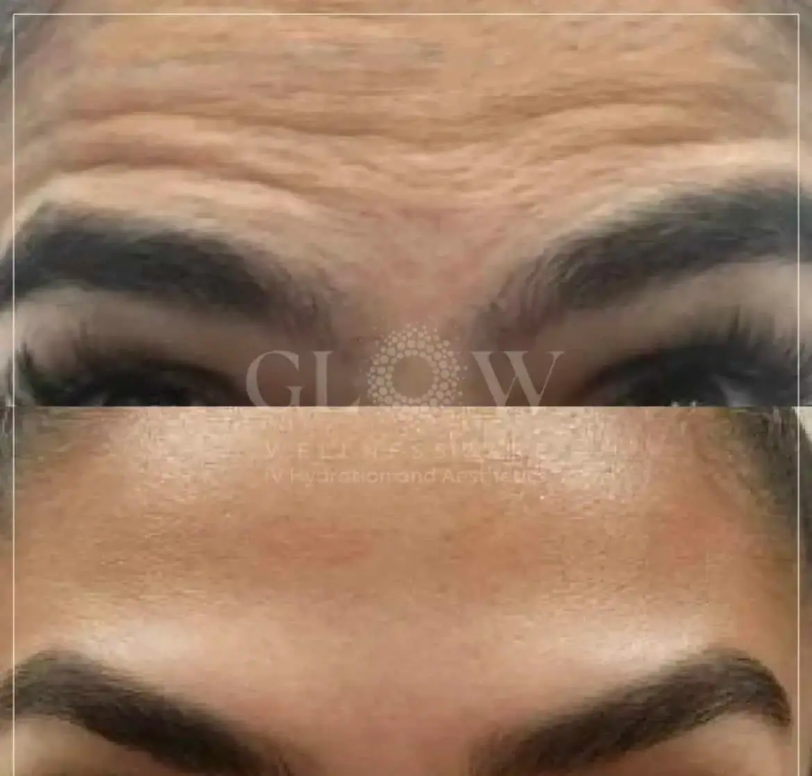 Botox Before-After