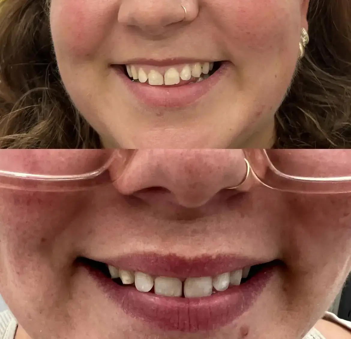 Lip Filler Before-After (1)