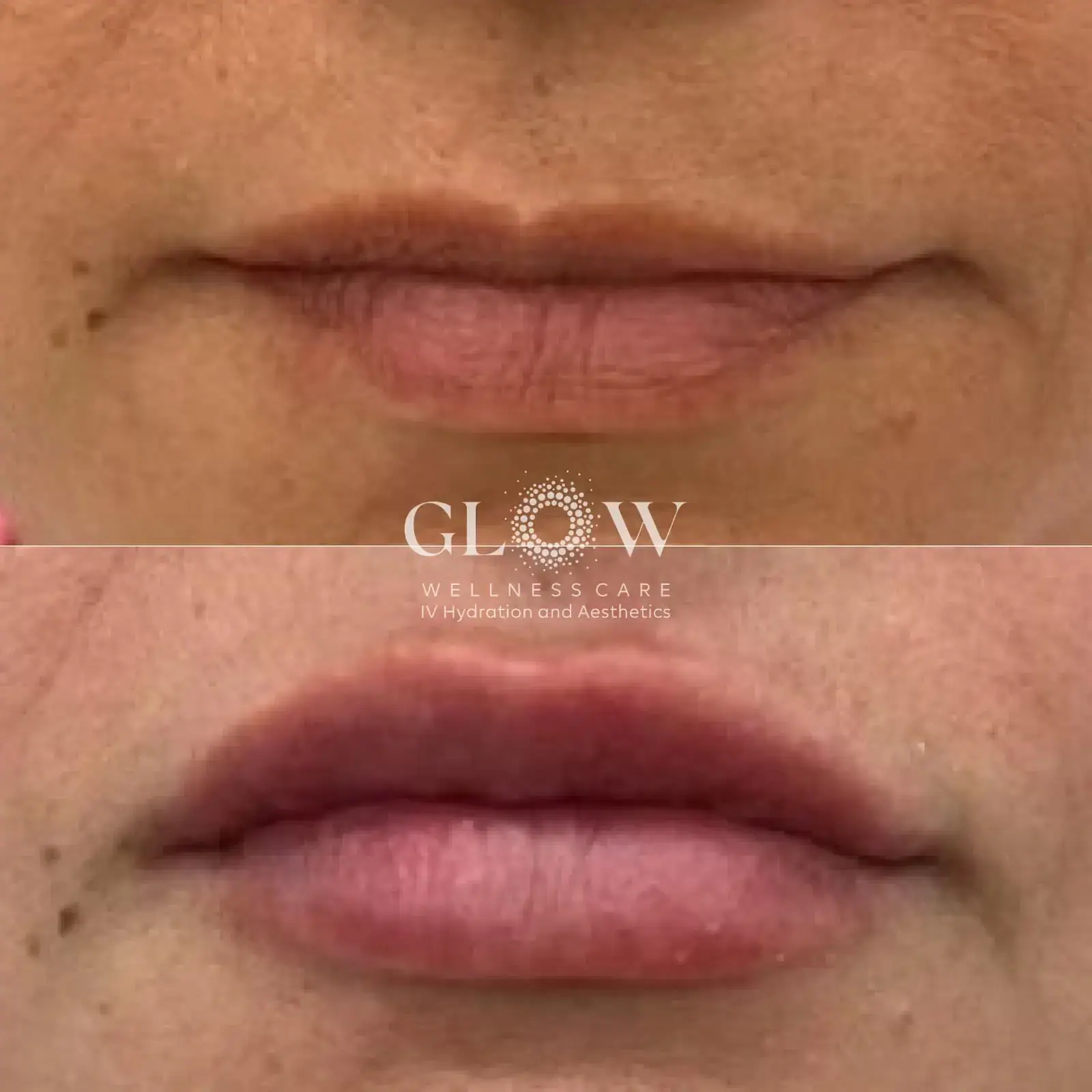 Lip Filler Before-After (10)