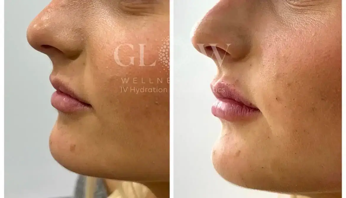 Lip Filler Before-After (13)