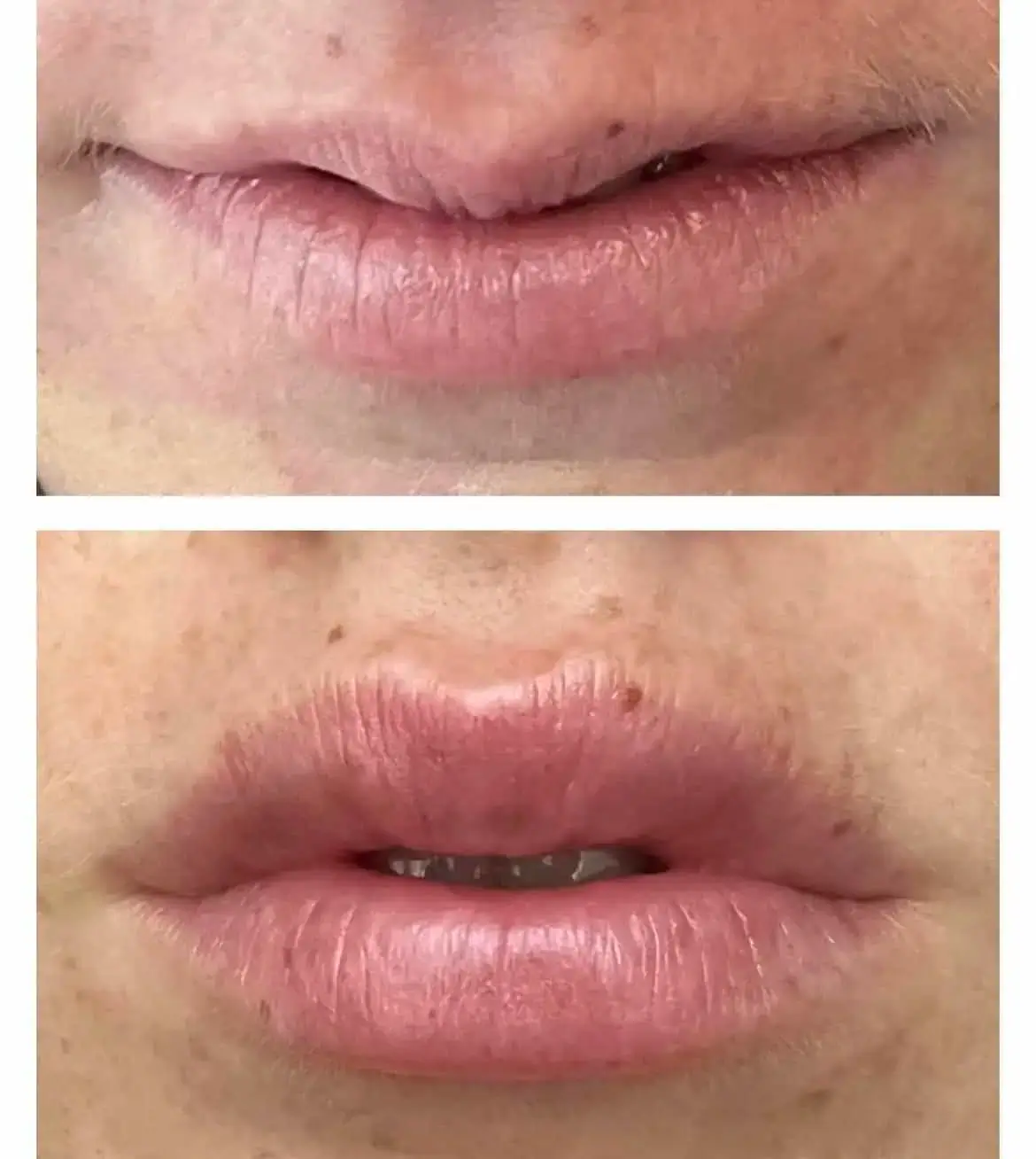 Lip Filler Before-After (2)