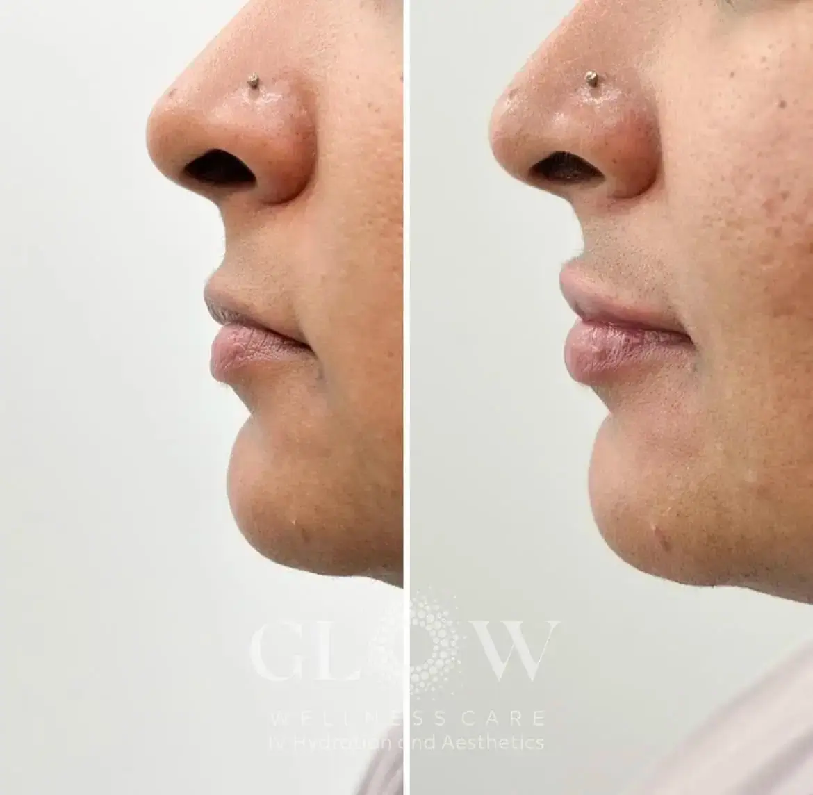 Lip Filler Before-After (3)