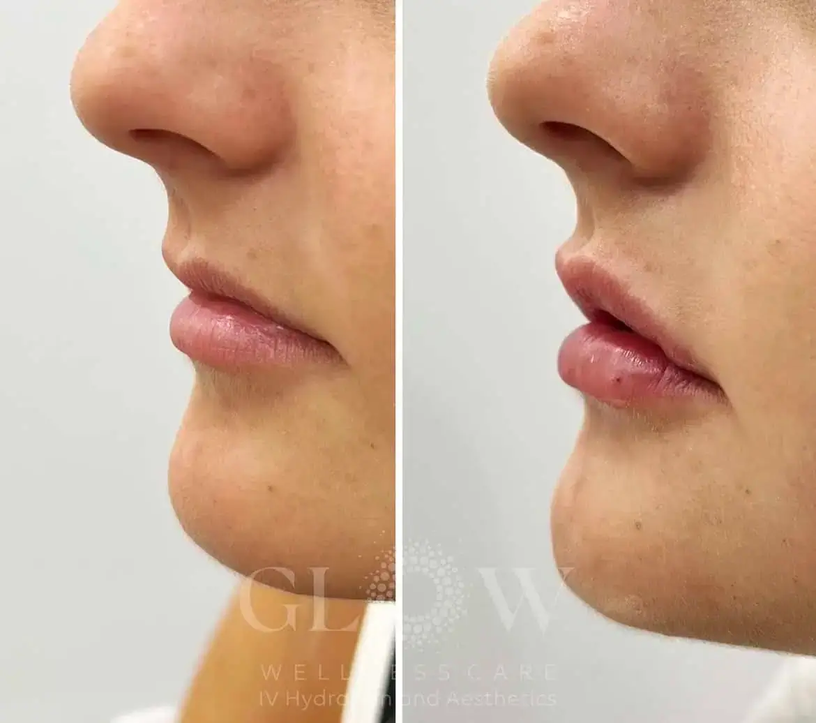 Lip Filler Before-After (4)