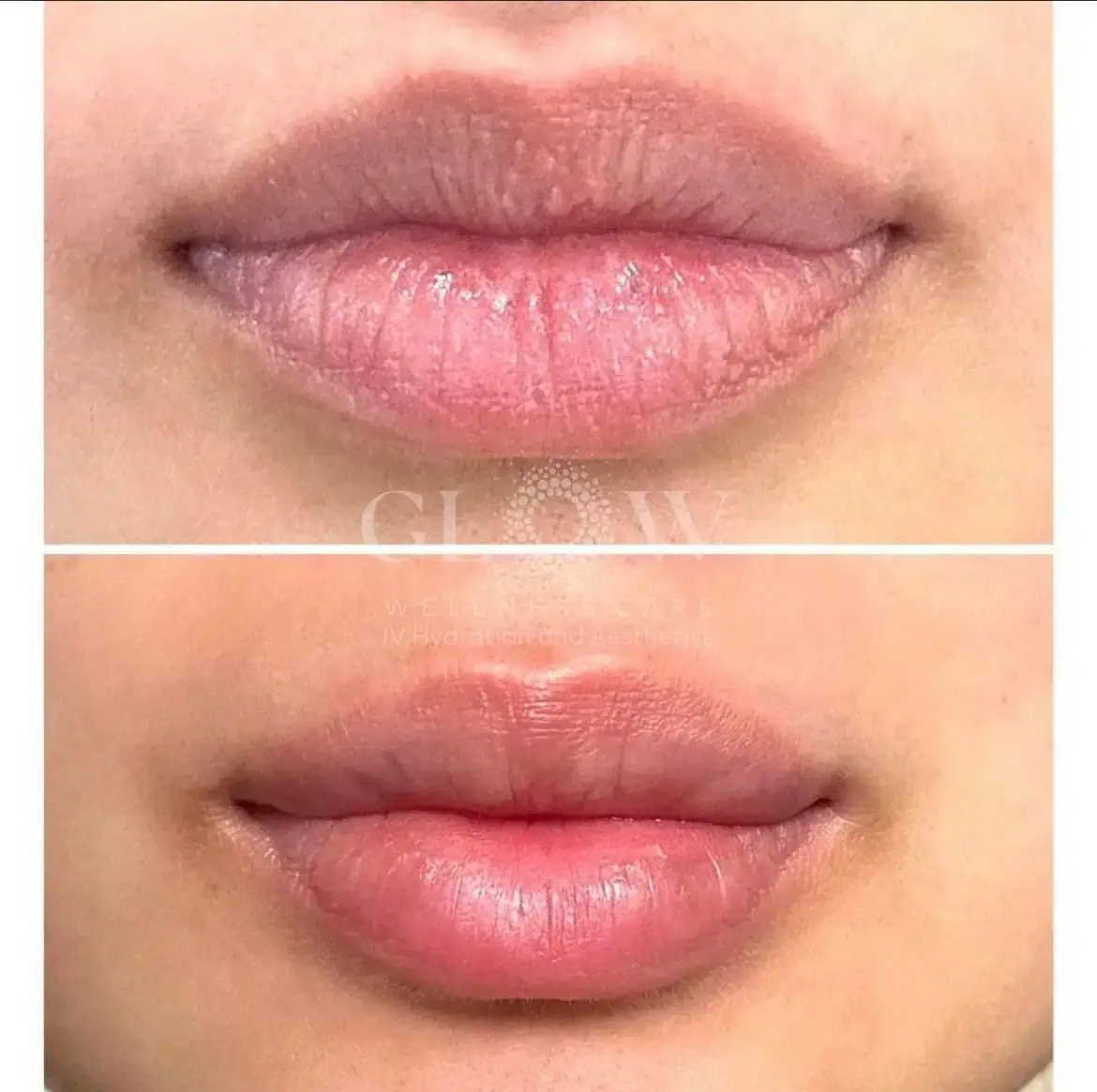 Lip Filler Before-After (5)