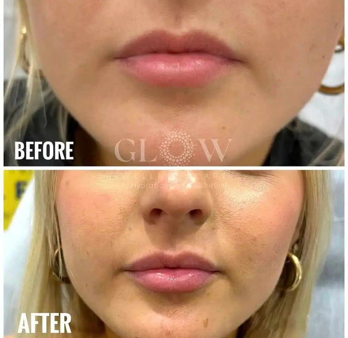 Lip Filler Before-After (6)