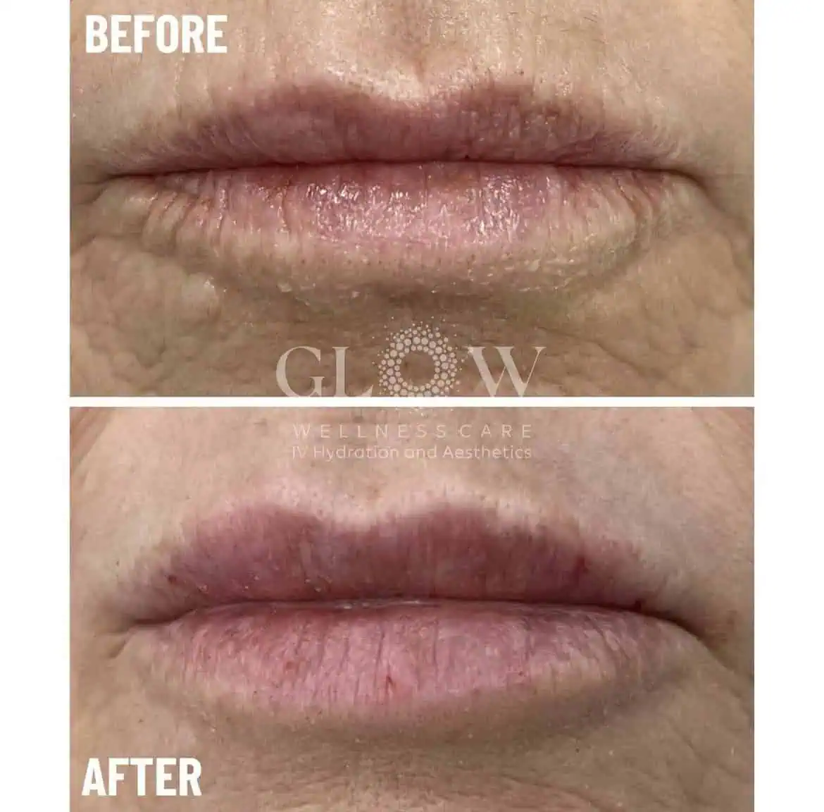 Lip Filler Before-After (7)