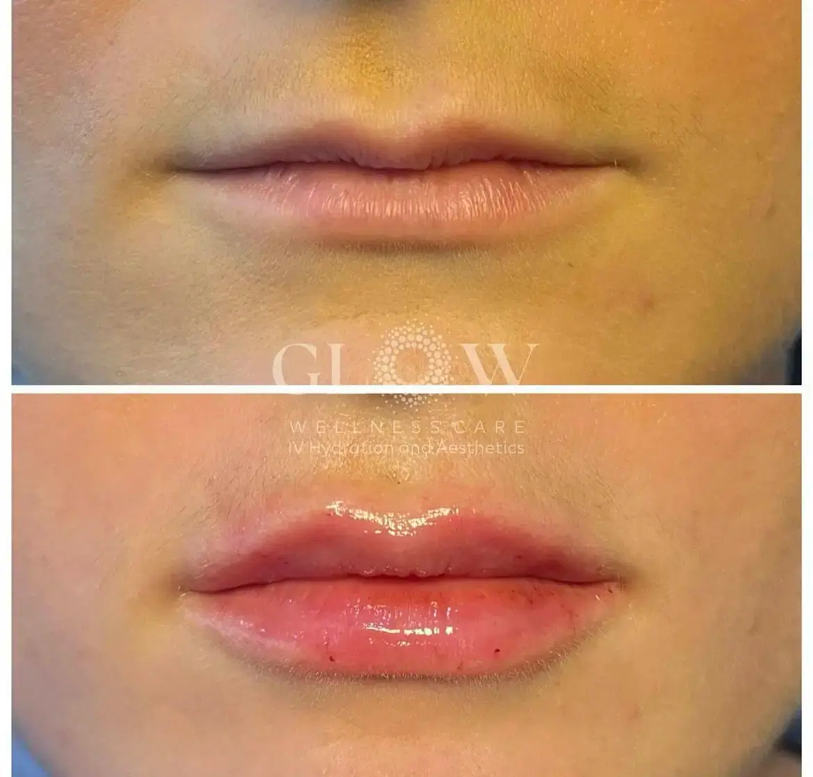 Lip Filler Before-After (8)