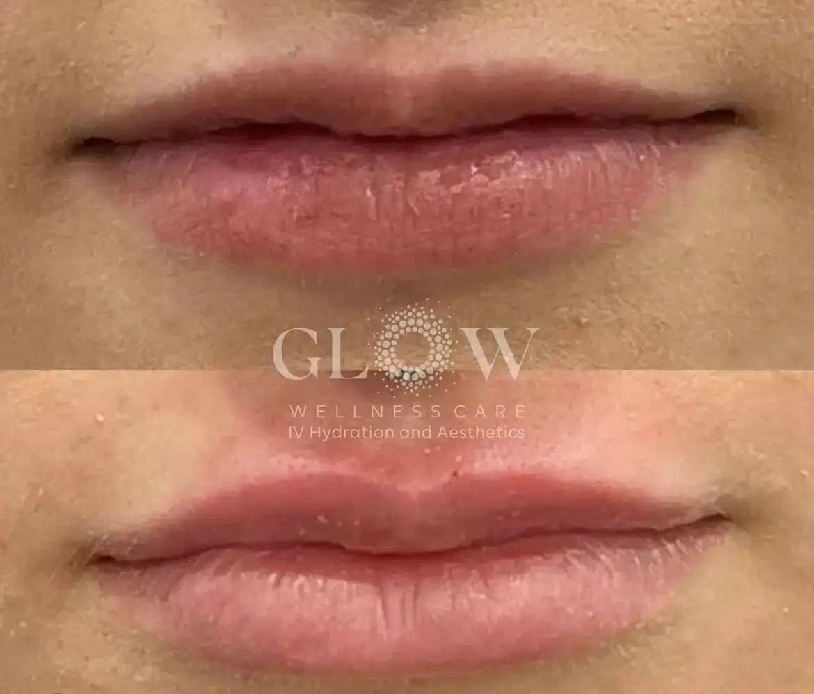 Lip Filler Before-After (9)