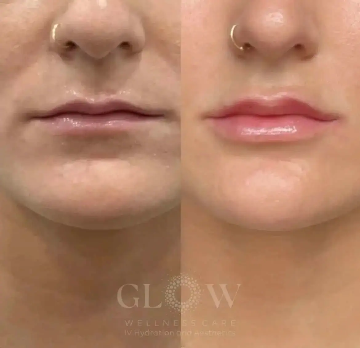 Lip Filler Before-After